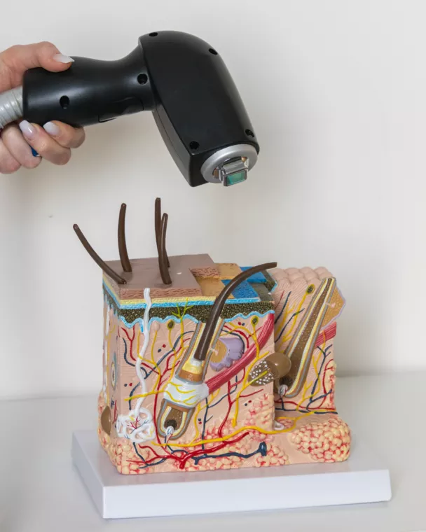 Max Laser (12 van 54) -  - Permanente laserontharing